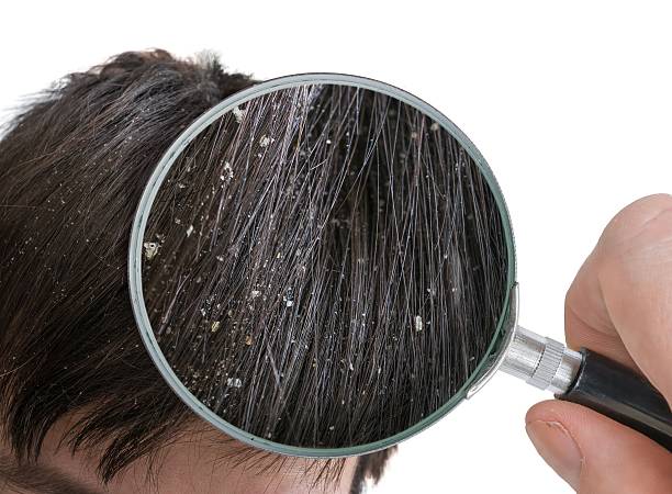 Dandruff Control